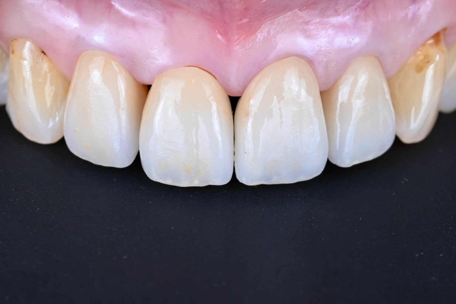 セラミック治療症例②_治療後