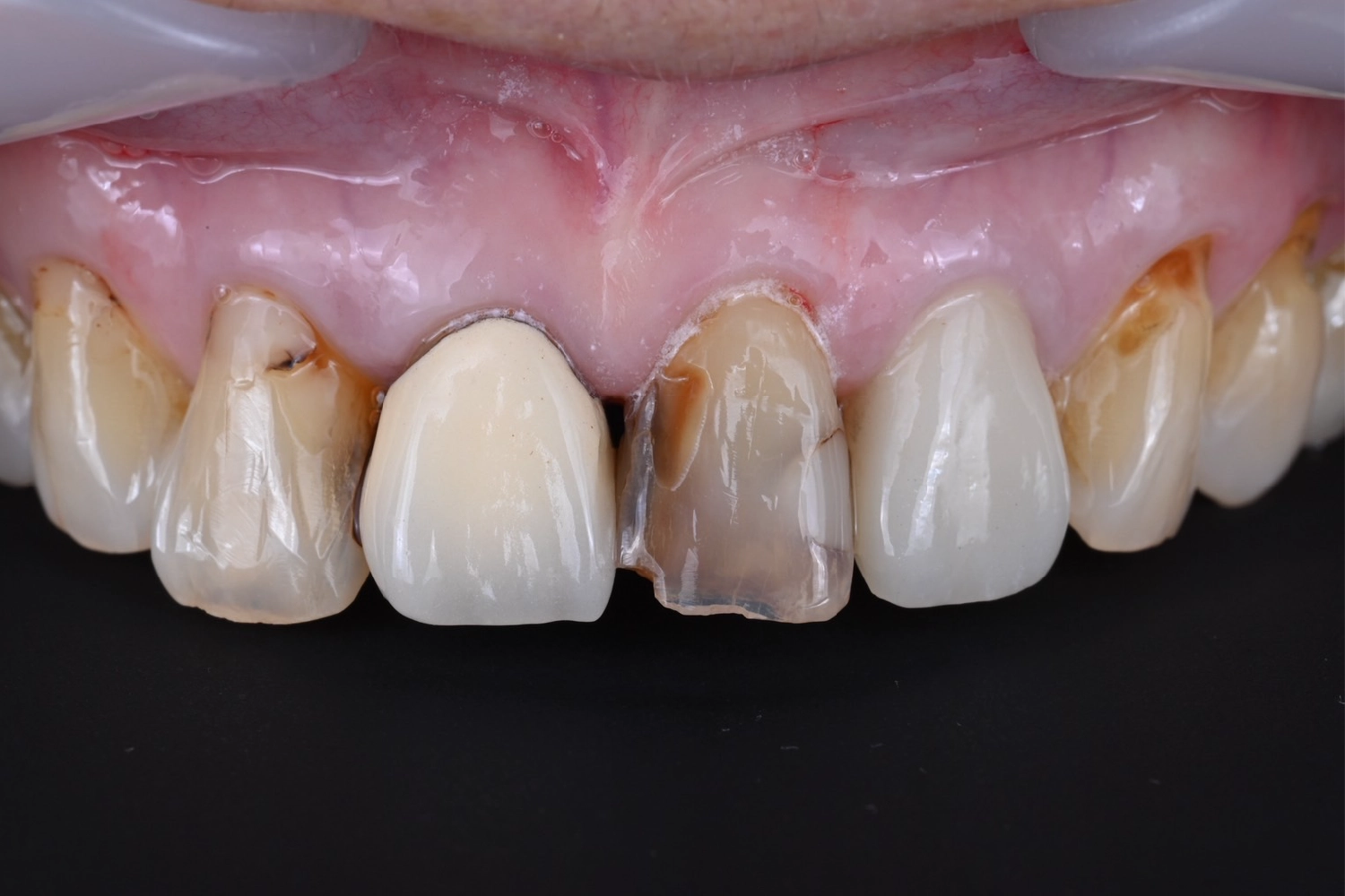 セラミック治療症例②_治療前