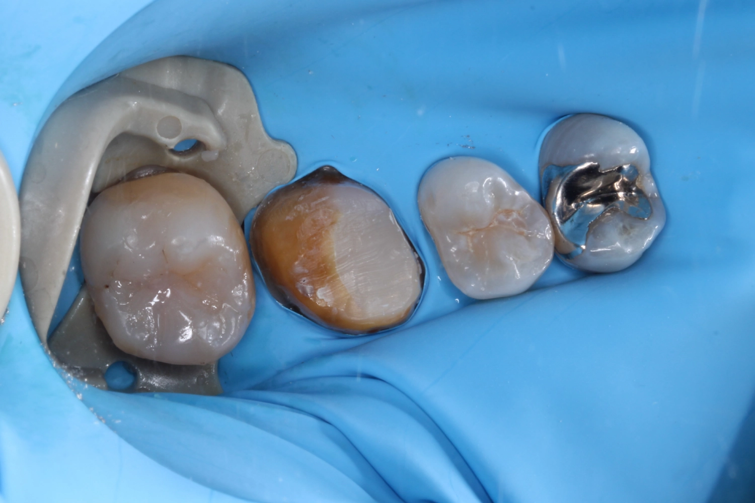 審美治療症例②_治療後