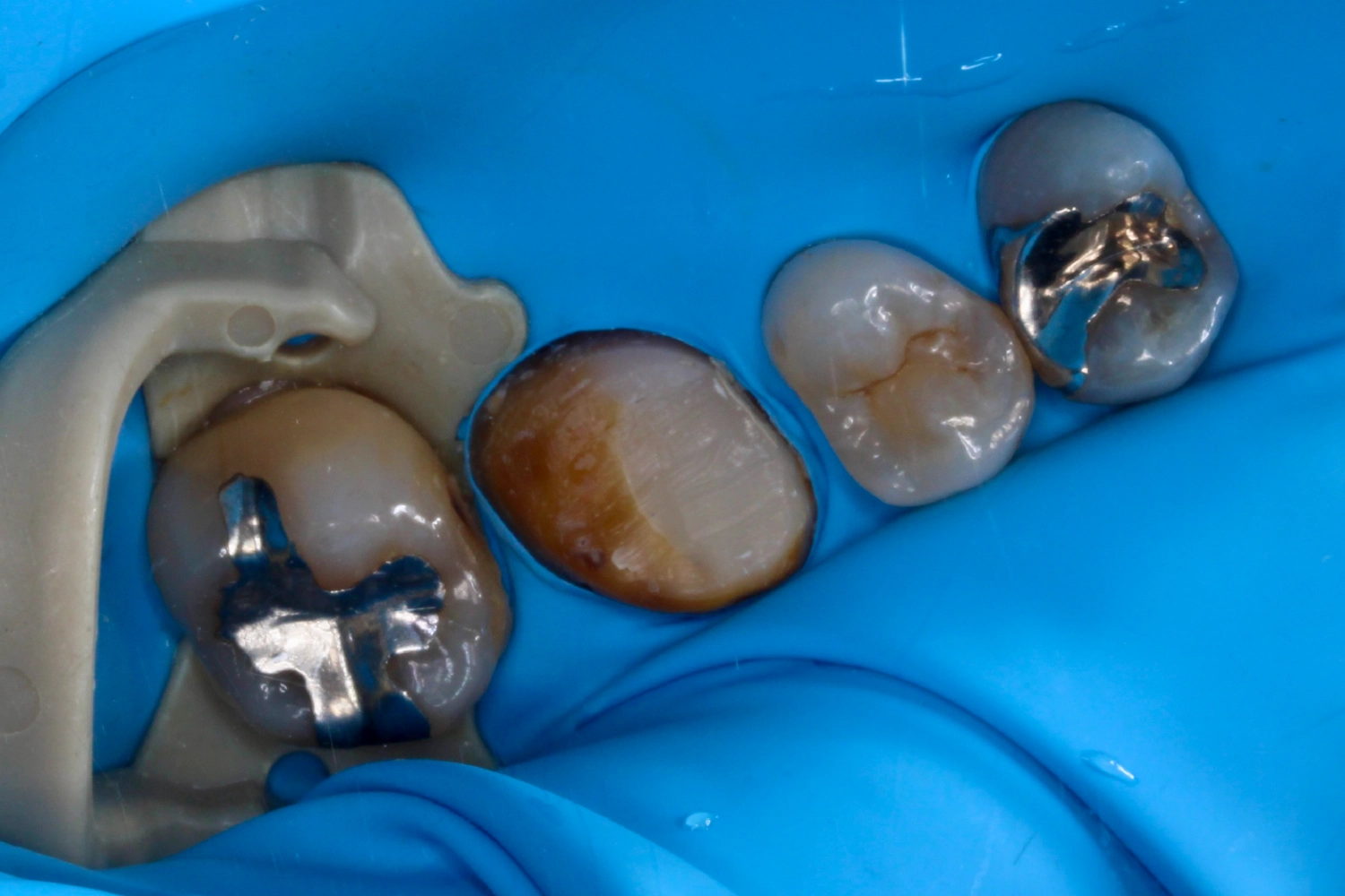 審美治療症例②_治療前