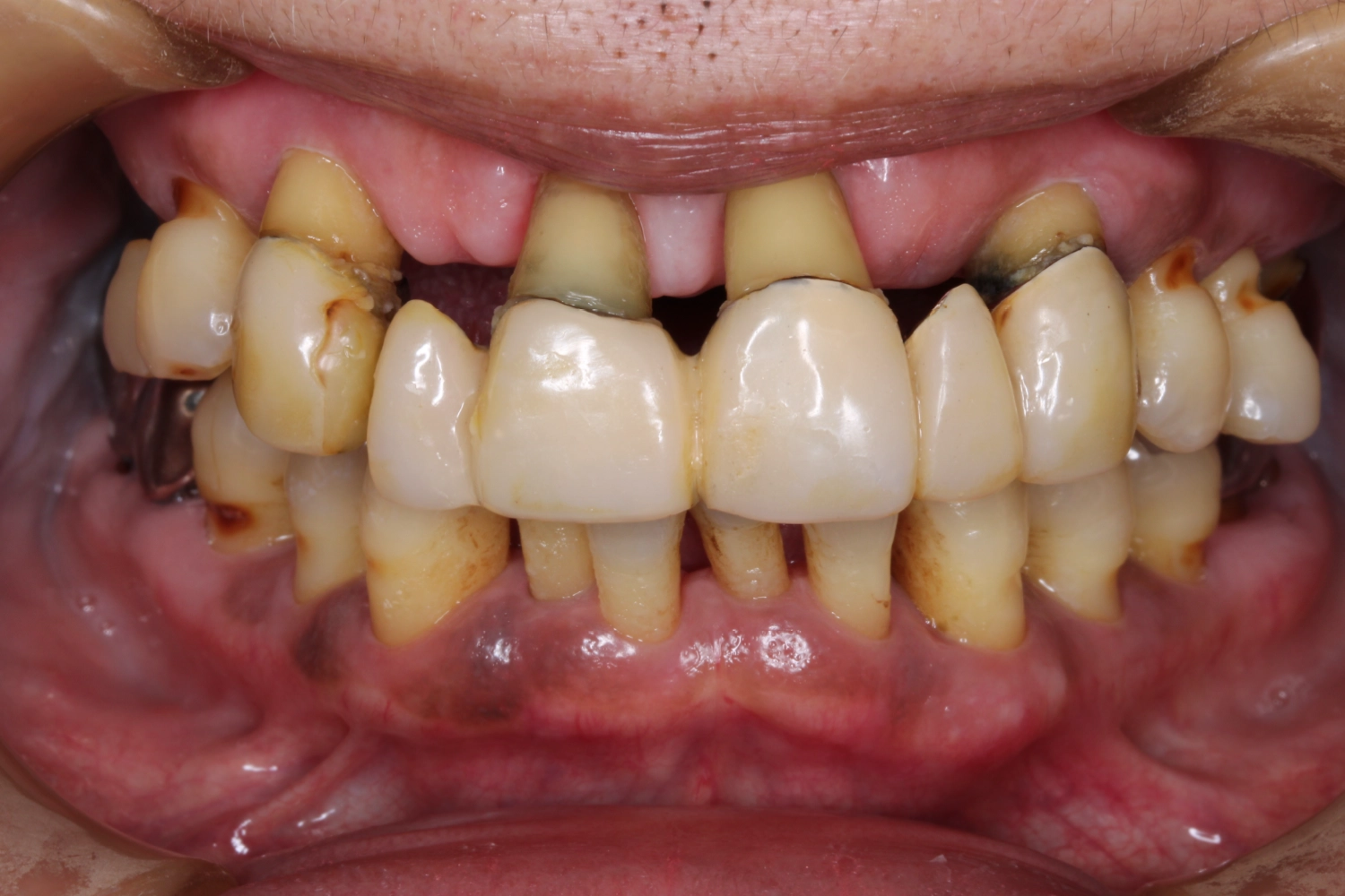 インプラント症例②_治療前